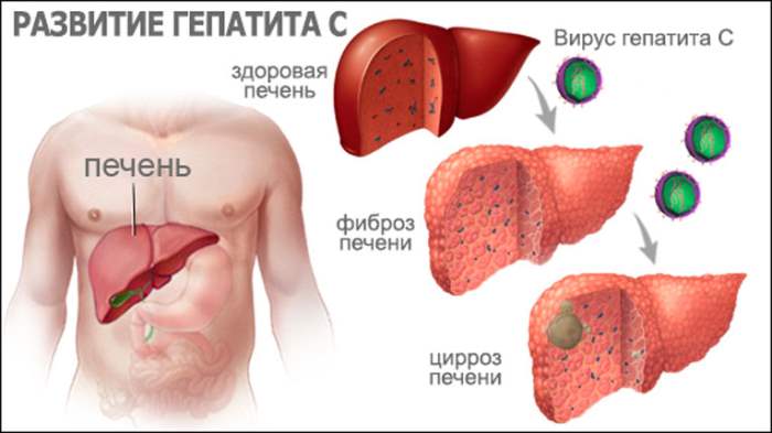 Гепатит C, лечение, гепатит,